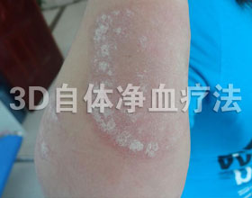 成都空军机关医院牛皮癣治疗中心 引起红斑狼疮的因素有哪些
